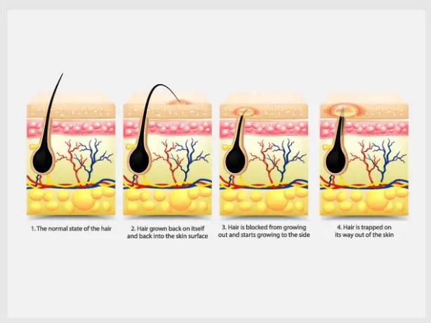 Essential Aftercare Tips to Avoid Ingrown Hairs