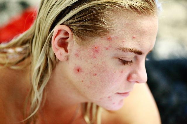 Understanding Acne and Its Causes