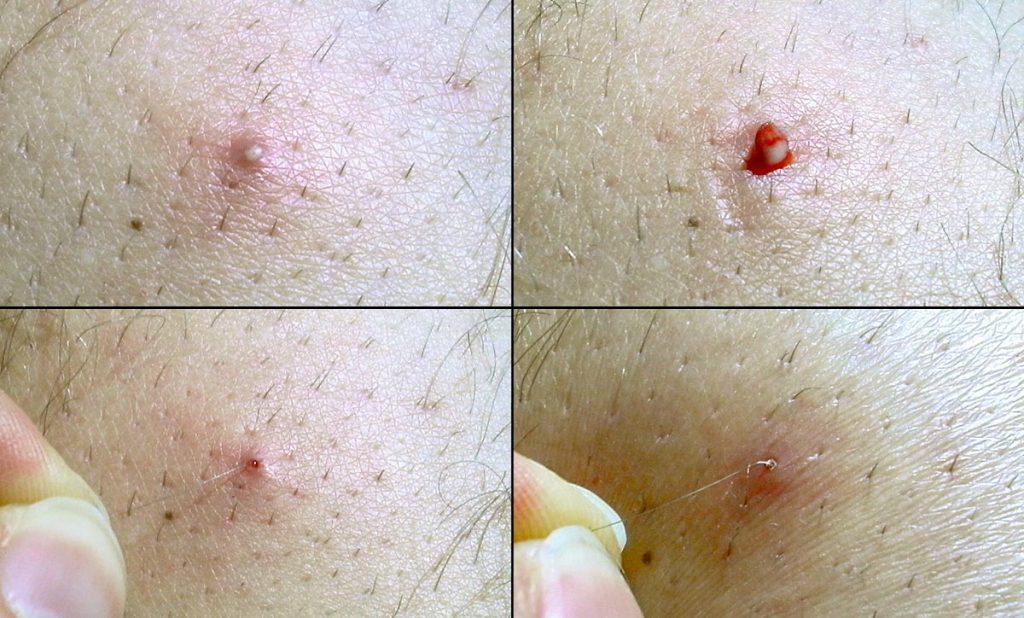 Effective ⁢At-Home Treatments for Ingrown ⁢Hairs