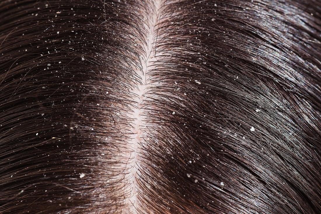 Understanding Dandruff and Its Causes